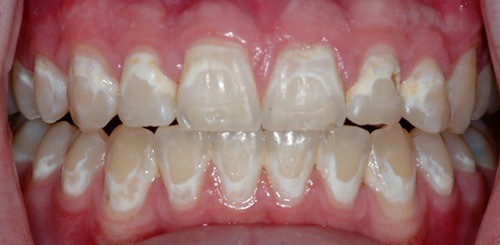 carie acuta demineralizarea smaltului davinci dental clinic